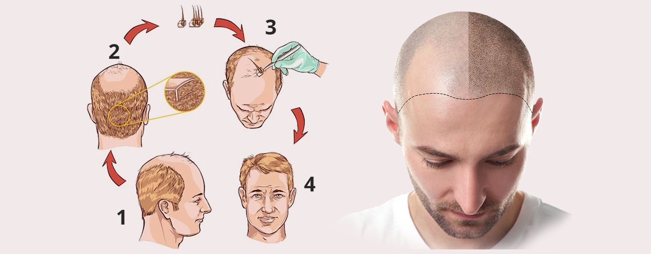 Ablauf einer Haartransplantation